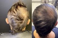 Perte de cheveux : les nouveaux traitements à découvrir au Québec